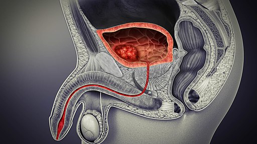 Bladder Cancer in the bladder of a male