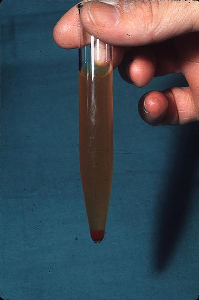 Hematuria, blood in the urine.