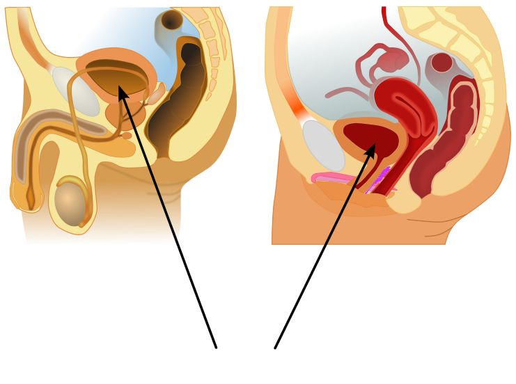 Bladder Cancer in the bladder of a male