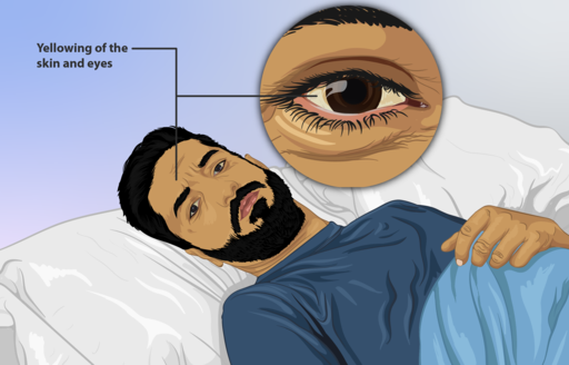 Depiction of a patient with jaundice.